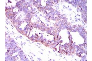 Immunohistochemical analysis of paraffin-embedded ovarian cancer tissues using CAMK4 mouse mAb with DAB staining. (CAMK4 antibody  (AA 35-292))