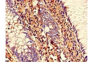 Immunohistochemistry of paraffin-embedded human colon cancer using ABIN7168833 at dilution of 1:100 (SENP1 antibody  (AA 63-214))