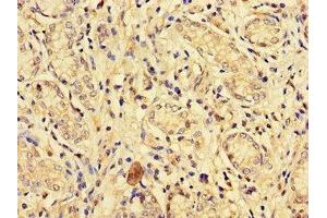 Immunohistochemistry of paraffin-embedded human gastric cancer using ABIN7151827 at dilution of 1:100