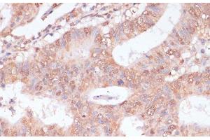 Immunohistochemistry of paraffin-embedded Human colon carcinoma using BYSL Polyclonal Antibody at dilution of 1:100 (40x lens). (Bystin-Like antibody)