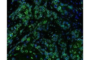 IF analysis of Emerin using anti-Emerin antibody (ABIN4886569) Emerin was detected in paraffin-embedded section of human oesophagus squama cancer tissues. (Emerin antibody  (N-Term))