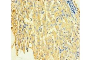 Immunohistochemistry of paraffin-embedded human liver cancer using ABIN7171249 at dilution of 1:100 (STX8 antibody  (AA 1-215))