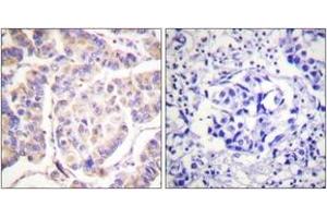 Immunohistochemistry analysis of paraffin-embedded human breast carcinoma tissue, using SYK (Ab-525) Antibody. (SYK antibody  (AA 491-540))