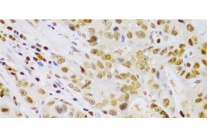 Immunohistochemistry of paraffin-embedded Human gastric cancer using IKK beta Polyclonal Antibody at dilution of 1:100 (40x lens).