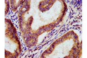 IHC image of ABIN7160339 diluted at 1:300 and staining in paraffin-embedded human endometrial cancer performed on a Leica BondTM system. (MEGF9 antibody  (AA 49-178))