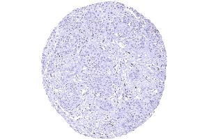 Muscle invasive urothelial carcinoma of the urinary bladder. (Recombinant NFIX antibody  (Center))