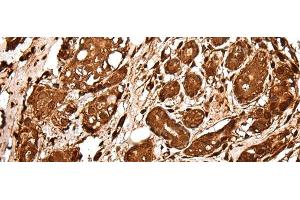Immunohistochemistry of paraffin-embedded Human breast cancer tissue using VCP Polyclonal Antibody at dilution of 1:30(x200) (VCP antibody)