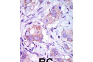Formalin-fixed and paraffin-embedded human cancer tissue reacted with the primary antibody, which was peroxidase-conjugated to the secondary antibody, followed by DAB staining. (MAP3K9 antibody  (C-Term))