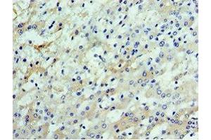 Immunohistochemistry of paraffin-embedded human liver cancer using ABIN7147929 at dilution of 1:100