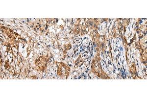 Immunohistochemistry of paraffin-embedded Human lung cancer tissue using LYPD4 Polyclonal Antibody at dilution of 1:25(x200) (LYPD4 antibody)