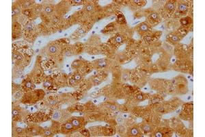 IHC image of ABIN7127448 diluted at 1:100 and staining in paraffin-embedded human liver cancer performed on a Leica BondTM system. (Recombinant CYP3A4 antibody)