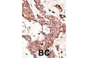 Formalin-fixed and paraffin-embedded human cancer tissue reacted with the primary antibody, which was peroxidase-conjugated to the secondary antibody, followed by AEC staining. (SIRT3 antibody  (C-Term))