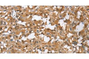 Immunohistochemistry of paraffin-embedded Human thyroid cancer tissue using MMP12 Polyclonal Antibody at dilution of 1:60 (MMP12 antibody)