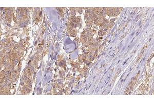 ABIN6266830 at 1/100 staining Human Melanoma tissue by IHC-P. (COL4A1 antibody)