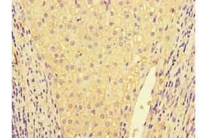 Immunohistochemistry of paraffin-embedded human liver cancer using ABIN7156891 at dilution of 1:100 (IL32 antibody  (AA 31-234))