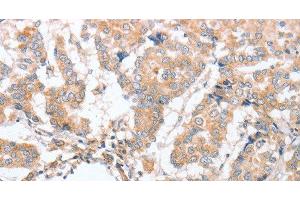 Immunohistochemistry of paraffin-embedded Human breast cancer tissue using PARD6A Polyclonal Antibody at dilution 1:60 (PARD6A antibody)