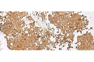 Immunohistochemistry of paraffin-embedded Human lung cancer tissue using GSTM2 Polyclonal Antibody at dilution of 1:50(x200) (GSTM2 antibody)