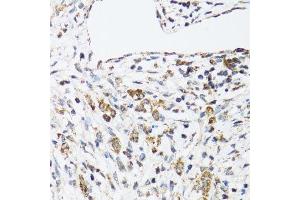 Immunohistochemistry of paraffin-embedded human uterine cancer using DHRS2 antibody. (DHRS2 antibody  (AA 1-300))