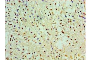 Immunohistochemistry of paraffin-embedded human breast cancer using ABIN7151444 at dilution of 1:100 (PHD1 antibody  (AA 283-407))