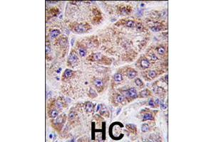 Formalin-fixed and paraffin-embedded human hepatocellular carcinoma reacted with FDPS polyclonal antibody  , which was peroxidase-conjugated to the secondary antibody, followed by DAB staining .