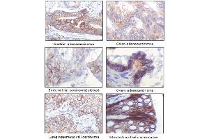Immunohistochemical analysis of paraffin-embedded human normal and tumor tissue, showing membrane location using IGF1R monoclonal antibody, clone 3C8B1  with DAB staining. (IGF1R antibody)