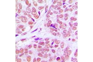 Immunohistochemical analysis of PCAF staining in human breast cancer formalin fixed paraffin embedded tissue section. (KAT2B antibody  (C-Term))