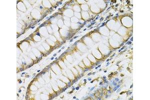 Immunohistochemistry of paraffin-embedded Human colon using PDGFB Polyclonal Antibody at dilution of 1:100 (40x lens). (PDGFB antibody)
