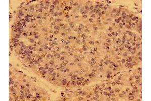 Immunohistochemistry of paraffin-embedded human liver cancer using ABIN7162766 at dilution of 1:100 (GDF15 antibody  (AA 16-143))