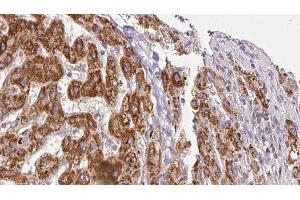 ABIN6278311 at 1/100 staining Human liver cancer tissue by IHC-P. (ITGA6 antibody  (N-Term))