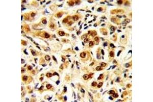 IHC analysis of FFPE human prostate carcinoma with GAPDH antibody (GAPDH antibody  (AA 233-259))