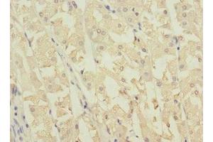 Immunohistochemistry of paraffin-embedded human gastric cancer using ABIN7162039 at dilution of 1:100 (NME3 antibody  (AA 20-169))