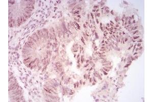 Immunohistochemical analysis of paraffin-embedded rectum cancer tissues using CBX2 mouse mAb with DAB staining.