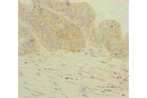 Immunohistochemistry of paraffin-embedded human colon cancer using ABIN7154305 at dilution of 1:100 (GORASP2 antibody  (AA 353-452))