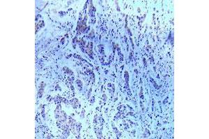 Immunohistochemical analysis of paraffin-embedded human breast carcinoma tissue using MAP3K5 polyclonal antibody . (ASK1 antibody)