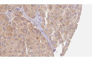 ABIN6277537 at 1/100 staining Human Melanoma tissue by IHC-P.