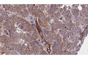ABIN6273609 at 1/100 staining Human liver cancer tissue by IHC-P. (BIN2 antibody  (Internal Region))