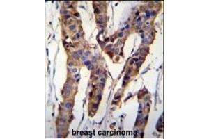 ZBT24 Antibody (N-term) (ABIN655829 and ABIN2845247) immunohistochemistry analysis in formalin fixed and paraffin embedded human breast carcinoma followed by peroxidase conjugation of the secondary antibody and DAB staining. (ZBTB24 antibody  (N-Term))