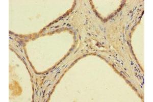 Immunohistochemistry of paraffin-embedded human prostate cancer using ABIN7144667 at dilution of 1:100 (AADAC antibody  (AA 24-399))
