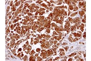 IHC-P Image LHR antibody [C3], C-term detects LHR protein at cytosol on human lung carcinoma by immunohistochemical analysis.