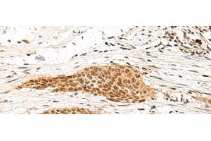 Immunohistochemistry of paraffin-embedded Human esophagus cancer tissue using MDFI Polyclonal Antibody at dilution of 1:55(x200) (MDFI antibody)