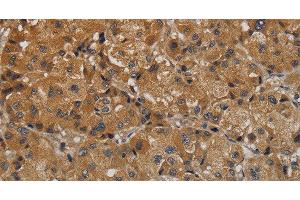 Immunohistochemistry of paraffin-embedded Human liver cancer tissue using TAB1 Polyclonal Antibody at dilution 1:40 (TAB1 antibody)