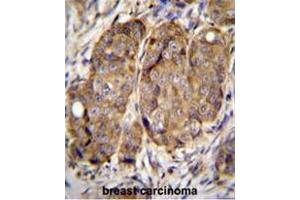 METTL2 Antibody (C-term) immunohistochemistry analysis in formalin fixed and paraffin embedded human breast carcinoma followed by peroxidase conjugation of the secondary antibody and DAB staining. (METTL2 antibody  (C-Term))