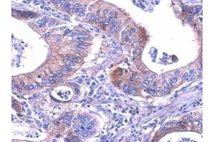 IHC-P Image LDH-B antibody detects LDHB protein at cytosol on human gastric cancer by immunohistochemical analysis. (LDHB antibody)