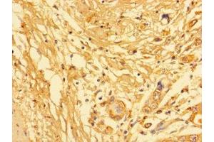 Immunohistochemistry of paraffin-embedded human pancreatic cancer using ABIN7157217 at dilution of 1:100 (Kallikrein 6 antibody  (AA 22-244))
