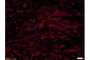 Formalin-fixed and paraffin embedded human gastric cancer labeled with Anti-UCP-1 Polyclonal Antibody, Unconjugated (ABIN675413) at 1:300 followed by conjugation to the secondary antibody and DAPI staining (UCP1 antibody  (AA 101-200))