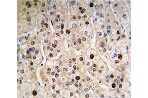 IHC analysis of FFPE human hepatocarcinoma tissue stained with anti-PCNA antibody (PCNA antibody  (AA 89-117))