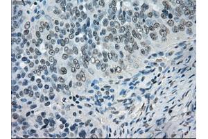 Immunohistochemical staining of paraffin-embedded Adenocarcinoma of breast tissue using anti-CRYAB mouse monoclonal antibody. (CRYAB antibody)
