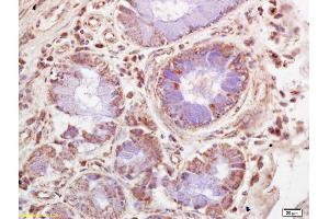 Formalin-fixed and paraffin embedded human lung carcinoma labeled with Rabbit Anti NUAK2 Polyclonal Antibody, Unconjugated (ABIN715106) at 1:200 followed by conjugation to the secondary antibody and DAB staining (NUAK2 antibody  (AA 31-130))