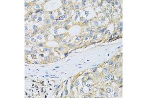 Immunohistochemistry of paraffin-embedded human breast cancer using SLC3A2 antibody. (SLC3A2 antibody  (AA 360-529))