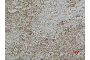 Immunohistochemistry (IHC) analysis of paraffin-embedded Human Breast Carcicnoma using CYCS Monoclonal Antibody. (Cytochrome C antibody)